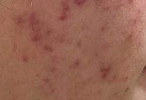 Những biến chứng da thường gặp do mỹ phẩm