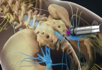 Thủy châm: Phương pháp điều trị kết hợp y học hiện đại và y học cổ truyền