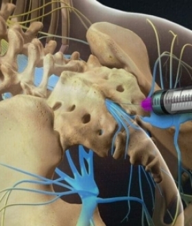 Thủy châm: Phương pháp điều trị kết hợp y học hiện đại và y học cổ truyền